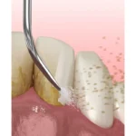 Ultrazvučno čišćenje zuba